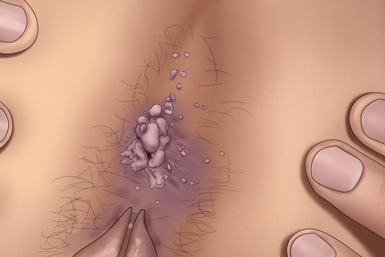 艾滋病感染性皮肤损害肛周手绘图