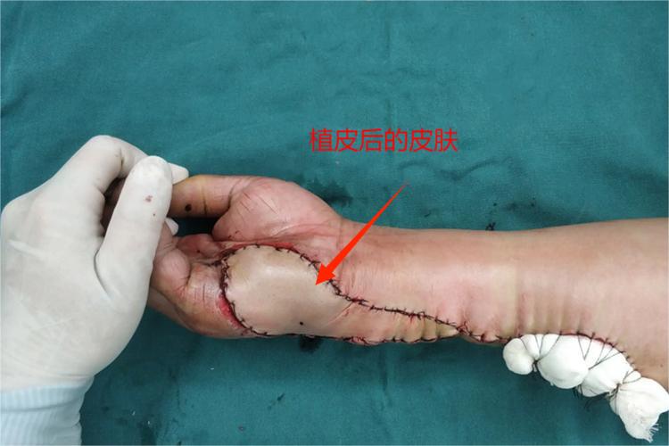 手植皮后的皮肤图