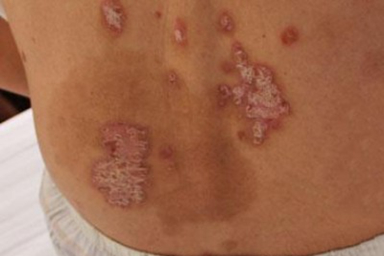 泛发性脓疱型银屑病脱屑图