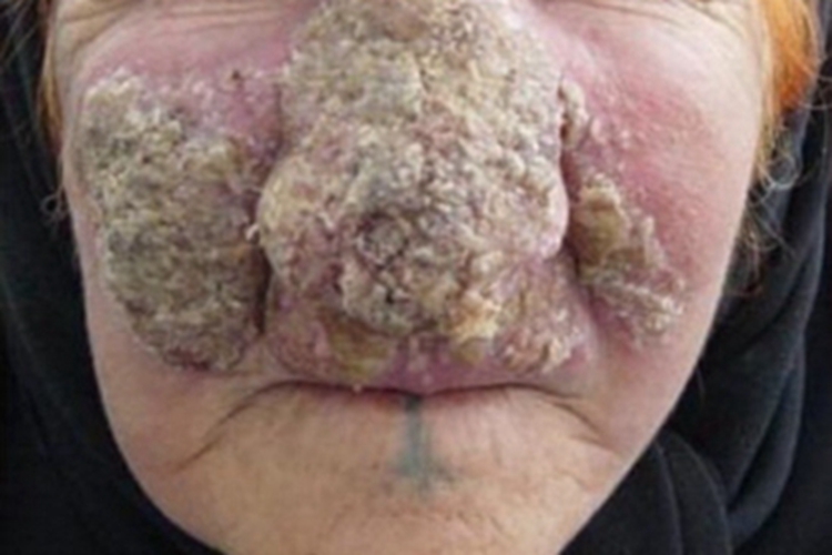 利什曼病面部黄痂图