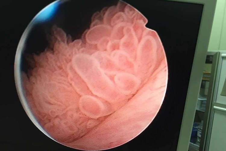 膀胱乳头状癌水草状 膀胱乳头状癌水草状