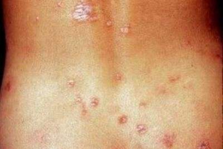 皮下型环状肉芽肿腰部症状图