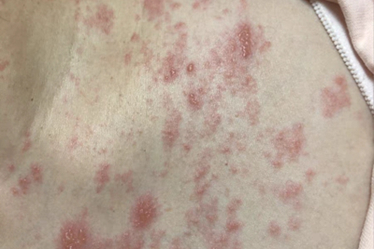 急性湿疹胸部图