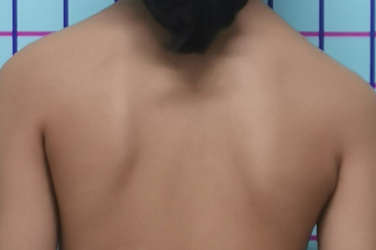 脊柱侧突畸形图