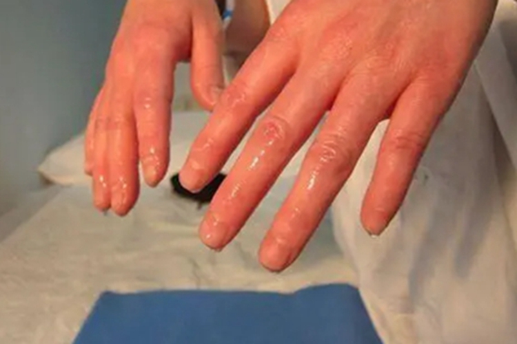 手汗症手部症状图