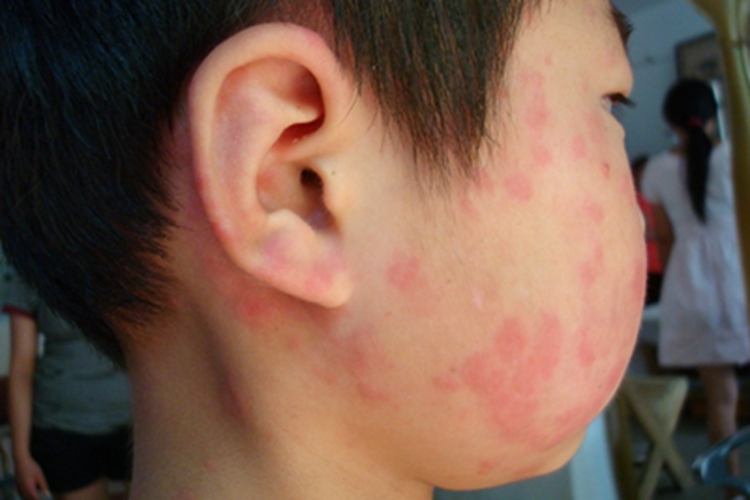 麻疹面部小红疙瘩图 麻疹面部小红疙瘩图