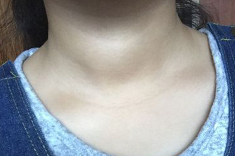 Ⅰ度甲状腺肿大图