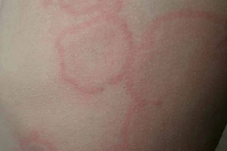 离心性环状红斑背部症状图 离心性环状红斑背部症状图