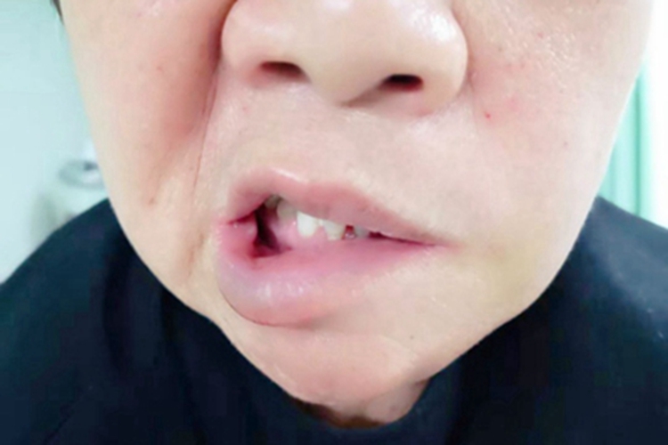 黏液表皮样癌变形图
