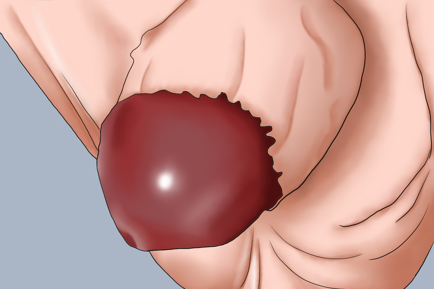 手术部位红肿图