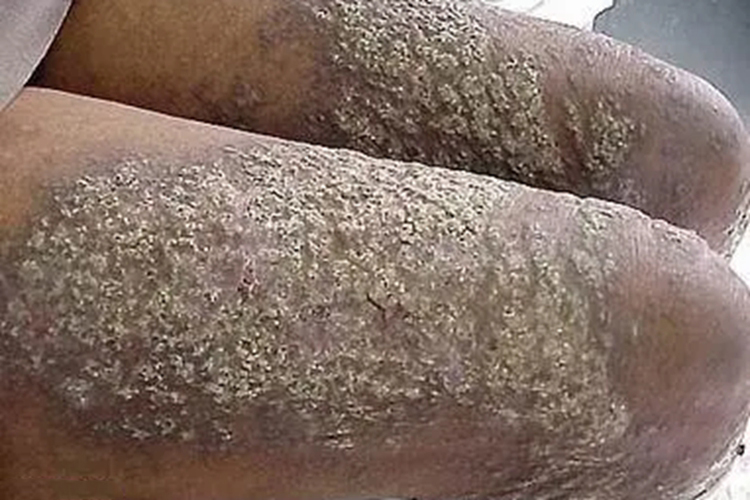 鳞状毛囊角化病鳞屑图