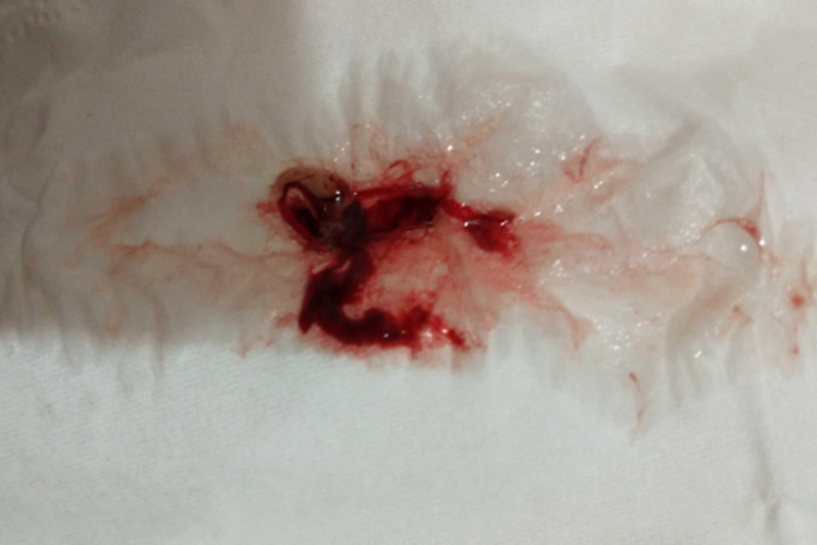 鼻黏膜脱落鼻涕带血图