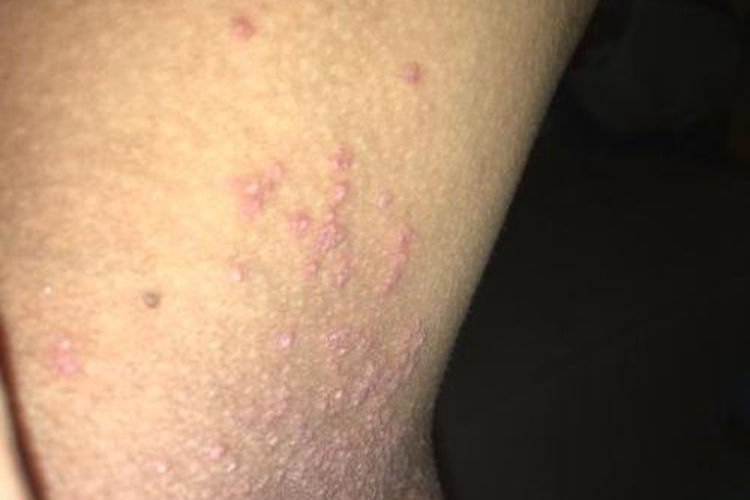 大腿内侧毛囊炎图 大腿内侧毛囊炎图