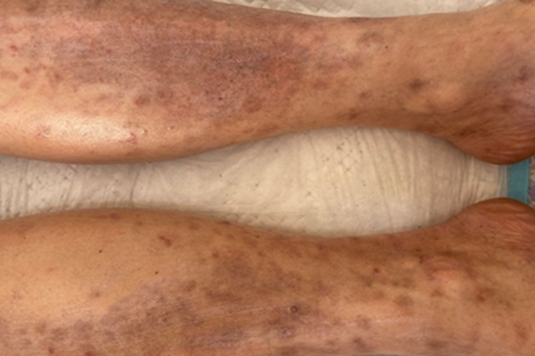 全身性瘙痒症小腿皮肤粗糙图