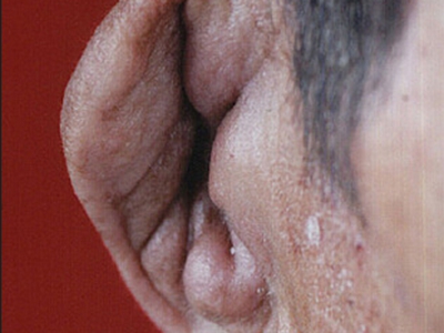 耳廓化脓性软骨膜炎耳廓皮肤变厚图.jpg