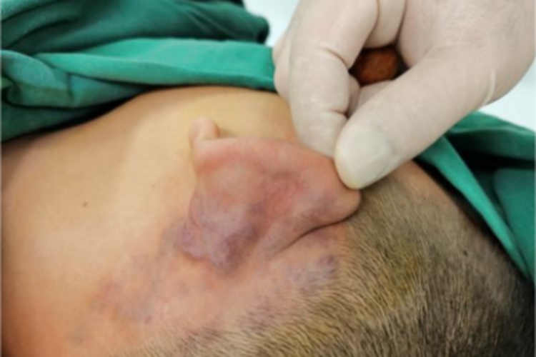 静脉畸形耳后包块图 静脉畸形耳后包块图