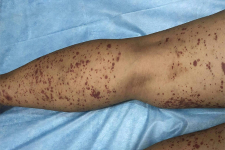 血栓性血小板减少性紫癜紫斑图 血栓性血小板减少性紫癜紫斑图