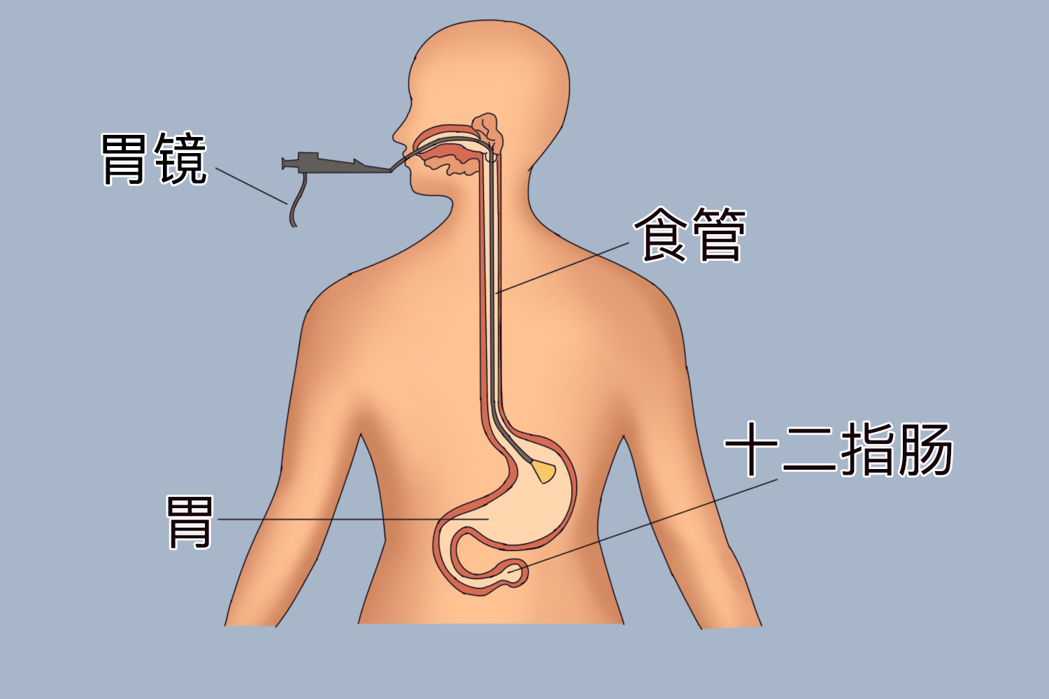 做胃镜的过程图