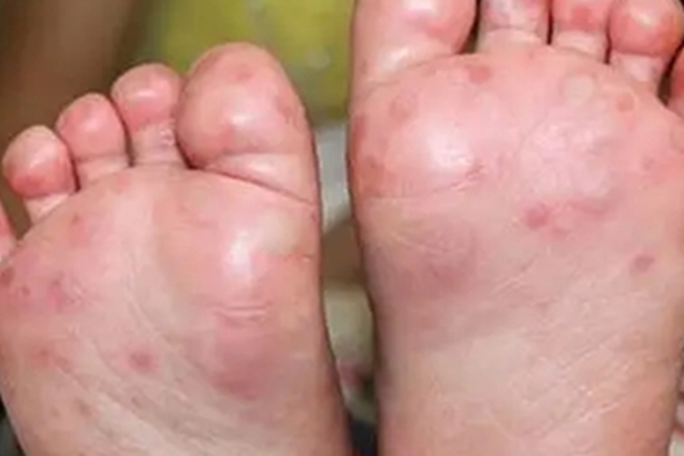 手足口病脚底红点图