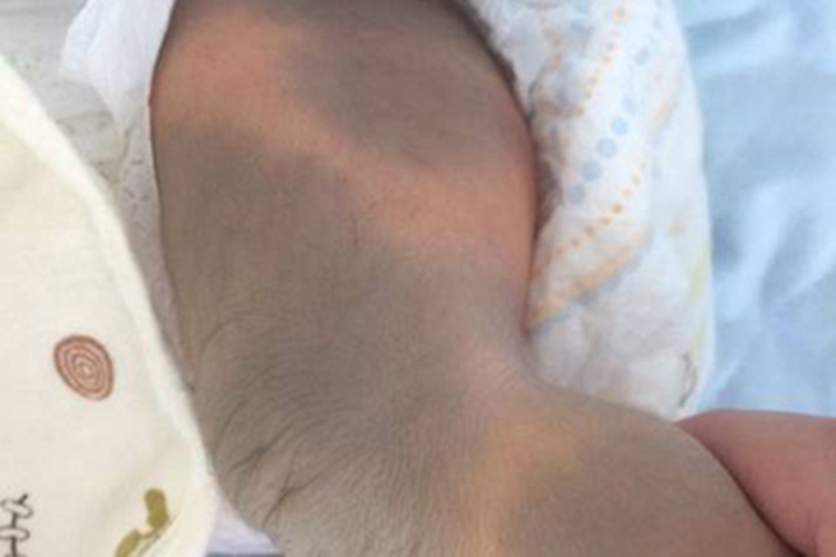 伊藤痣腿症状图