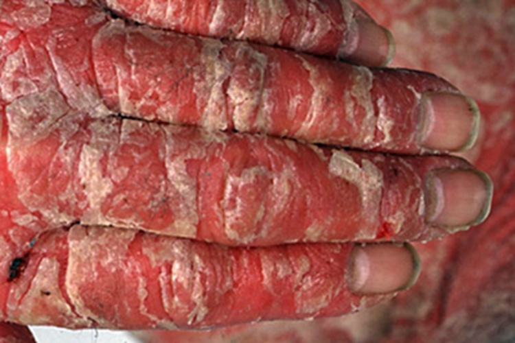 银屑病手部红斑鳞屑图