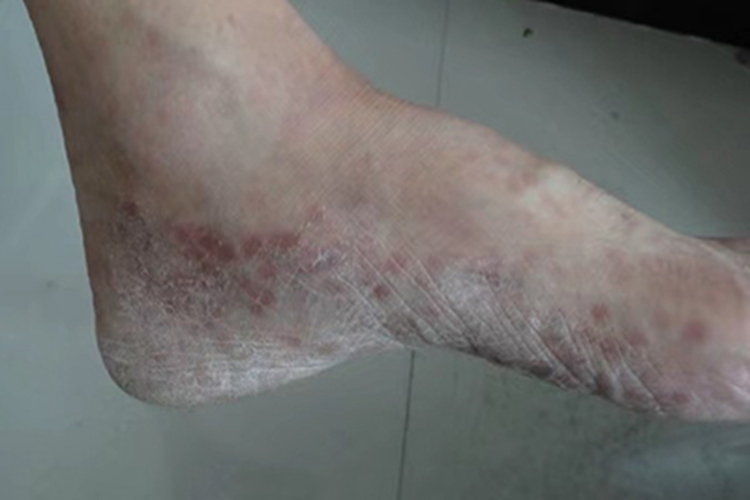 鳞屑角化型足癣皮肤粗糙图