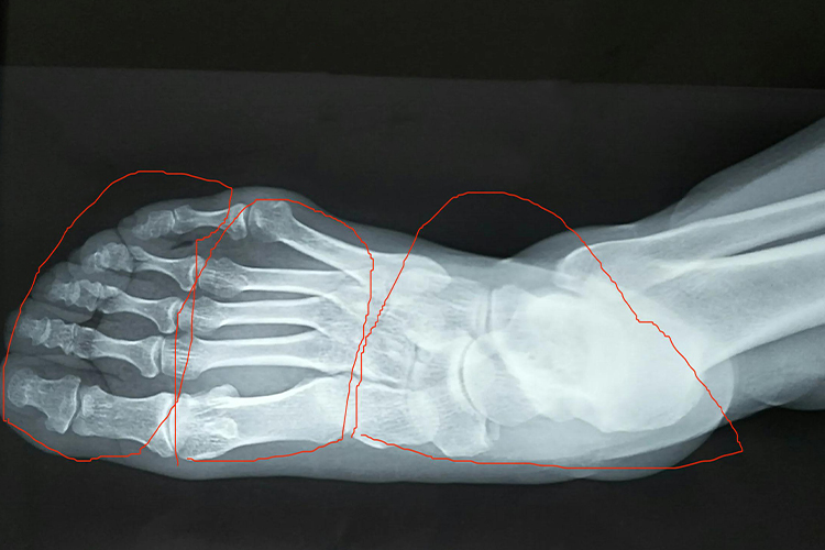 正常足部X线影像图 正常足部X线影像图