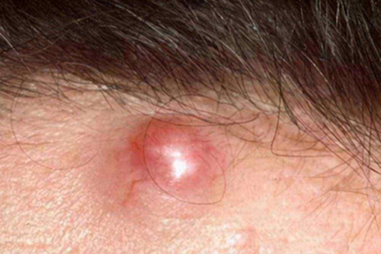 表皮样囊肿症状图 表皮样囊肿症状图