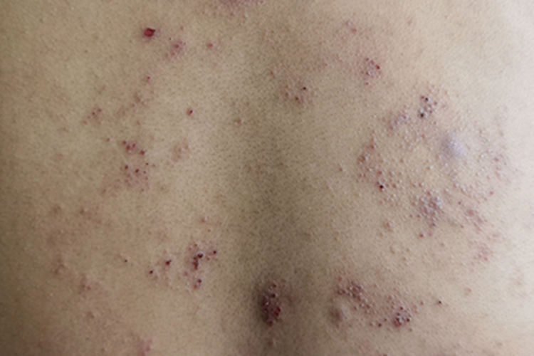 干性湿疹后背有很多血痂图