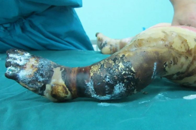 Ⅲ度烧伤图 Ⅲ度烧伤图