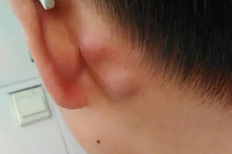脂肪瘤耳后软包图