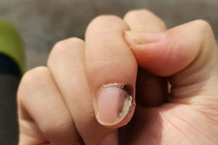 寻常疣手指甲有一块黑斑图