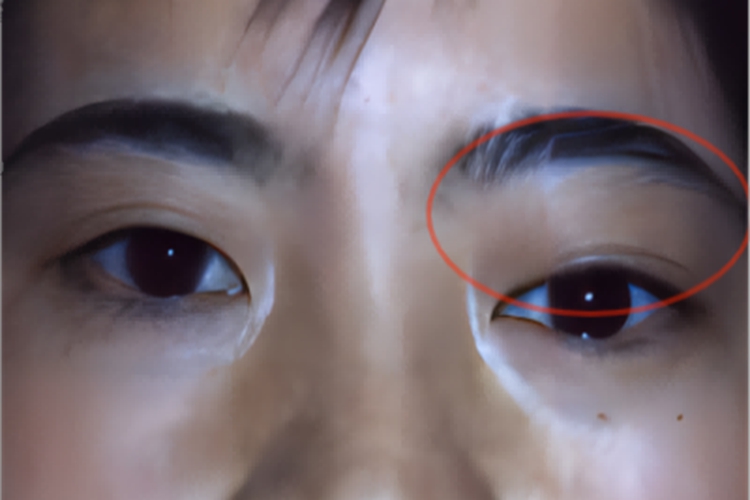 眼眶神经鞘瘤眼部肿图