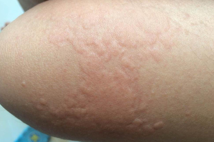 大腿急性荨麻疹图