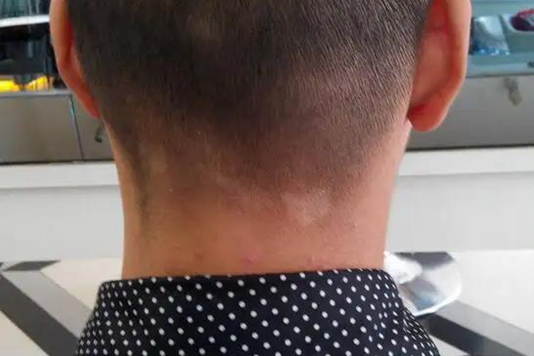 脖子白色糠疹白块图 脖子白色糠疹白块图