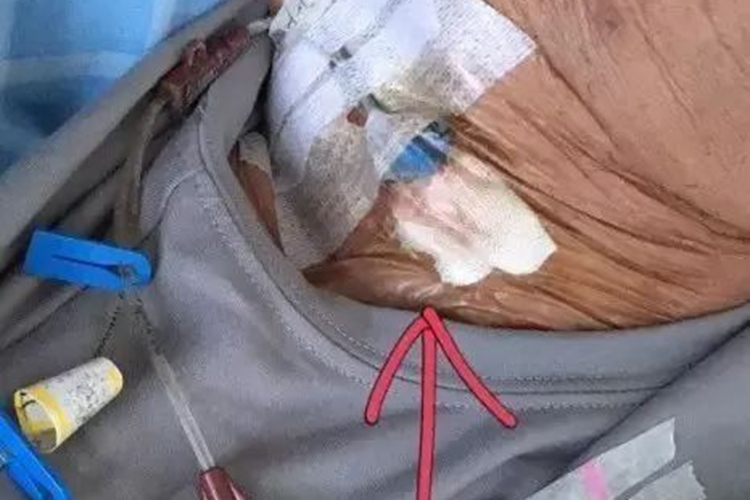 脖子上深静脉留置针图