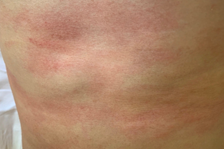 过敏性皮炎背部有大片红斑图