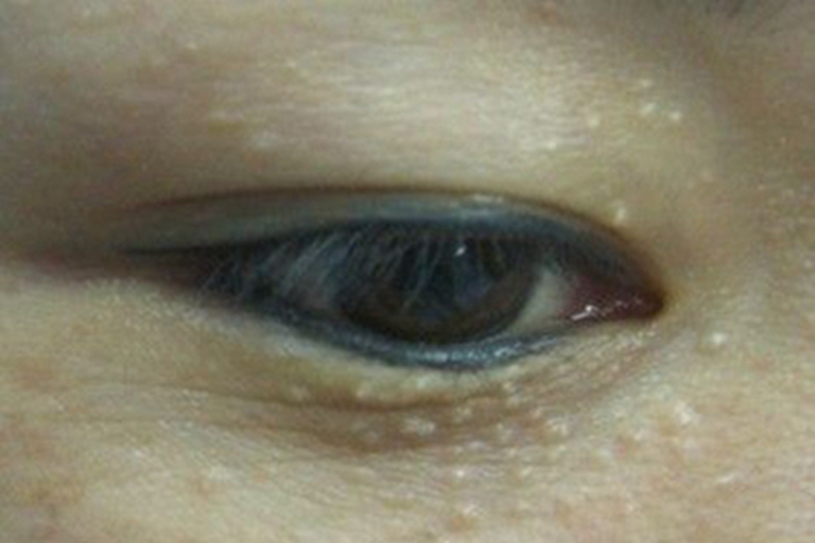 汗管瘤眼周长密集白色丘疹图 汗管瘤眼周长密集白色丘疹图