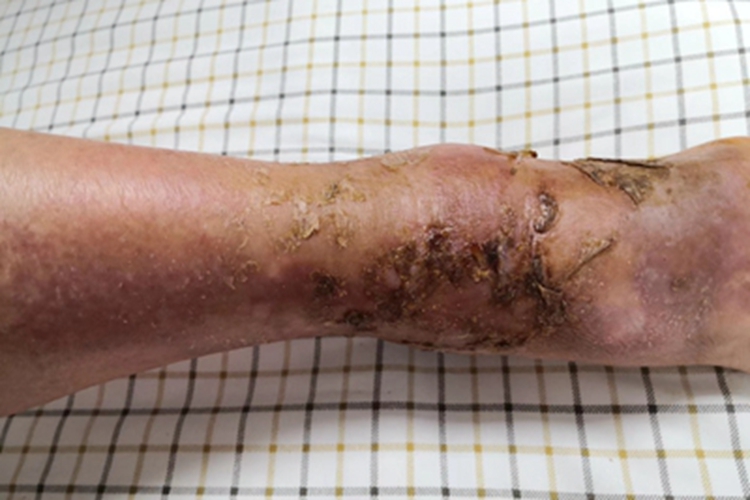 变应性接触性皮炎脚踝结痂图