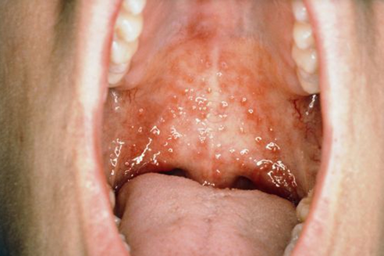 疱疹性龈口炎:好发于口腔,牙龈,舌,硬腭,咽等部位