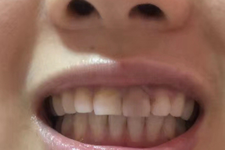 死髓牙牙齿发黄有黑斑图