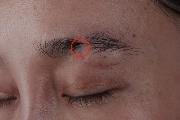 眉毛缝针长好后图