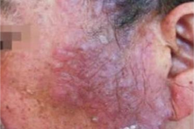 骨嗜酸性粒细胞肉芽肿红斑图