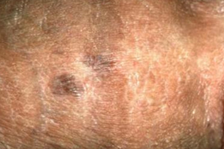 鲍温样丘疹病阴囊丘疹图