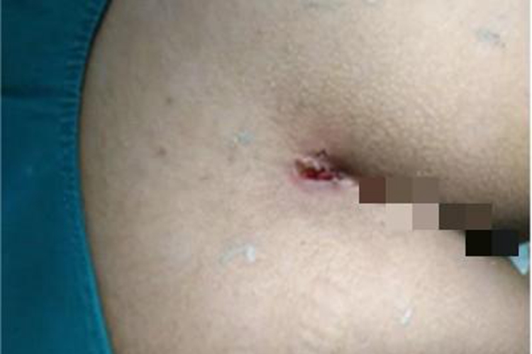 藏毛窦臀部有一块脓肿图 藏毛窦臀部有一块脓肿图