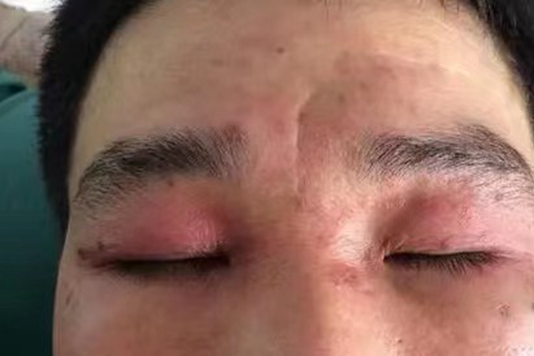 上眼皮接触性皮炎图 上眼皮接触性皮炎图