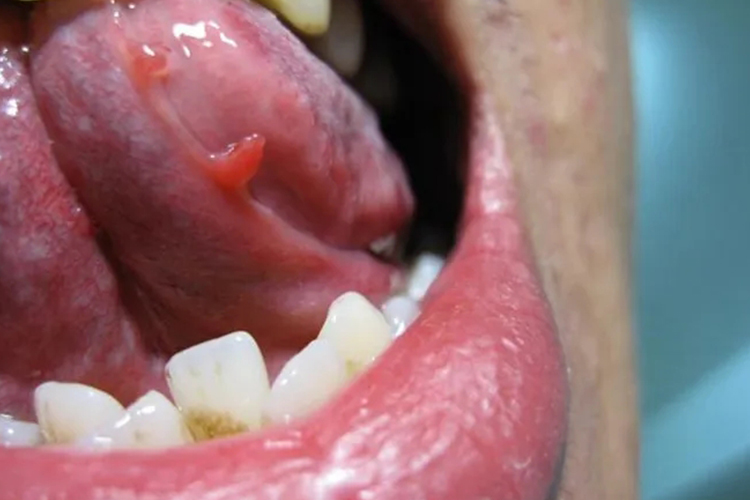 口腔尖锐湿疣片状赘生物图 口腔尖锐湿疣片状赘生物图