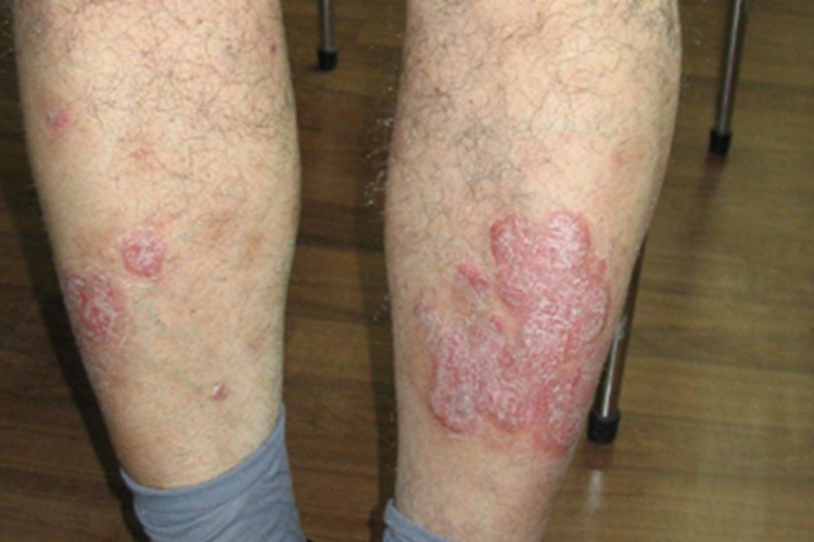 青年成人期特应性皮炎增厚图 青年成人期特应性皮炎增厚图