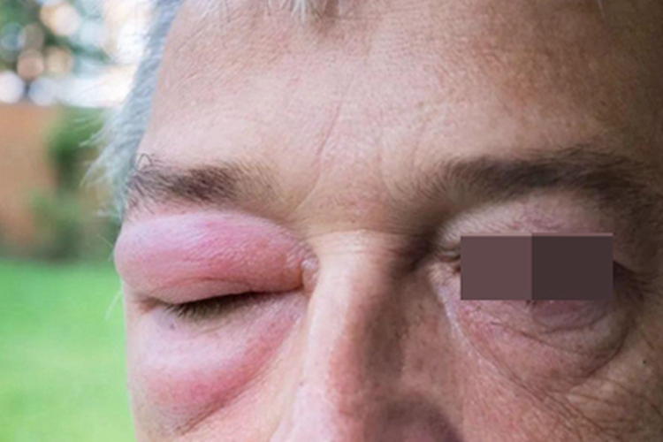 旋毛虫病症状图