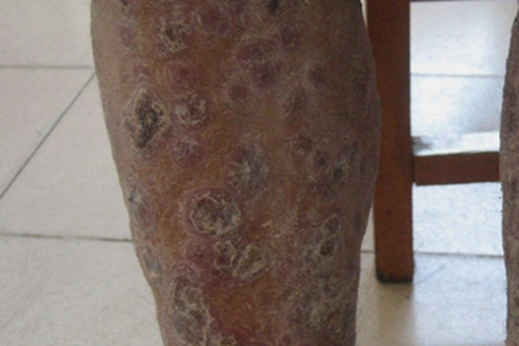 结节性梅毒疹腿部症状图